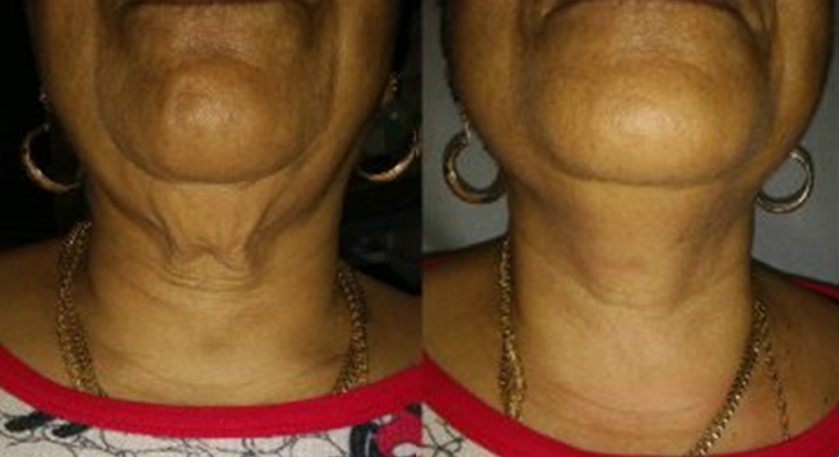 InMode LiFT鑽石超塑 三合一全方位V面瘦臉 $2,500擁有明星輪廓